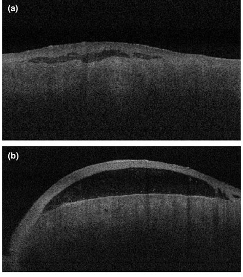 A Optical Coherence Tomography Oct Image Shows A Subepithelial