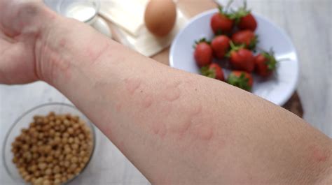 Jak Souvis Potravinov Alergie A Intolerance S R Stov Hormon