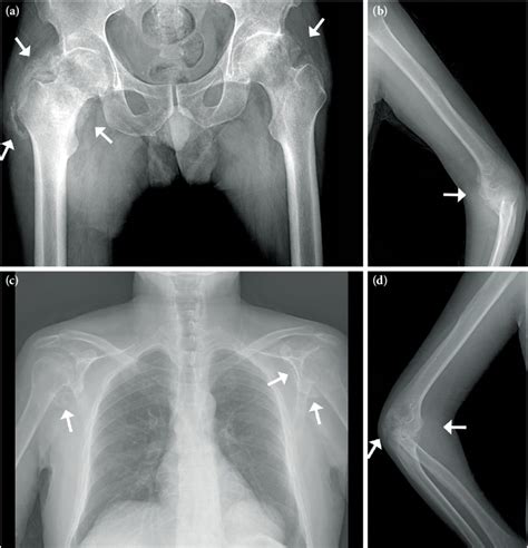 A Pelvic Radiograph Anteroposterior View The Radiograph Showing