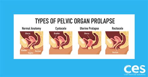 Uterine Prolapse Uterus Vagina Pelvic Floor Muscles Bladder Patient Hysterectomy Ph
