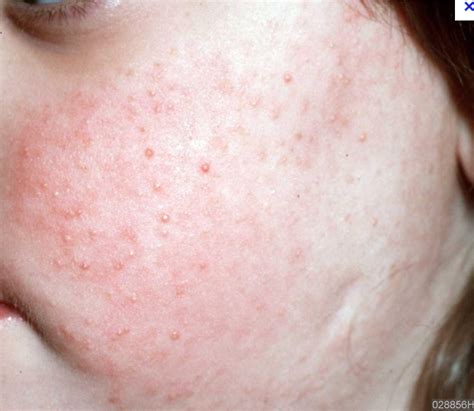 Top Pictures Keratosis Pilaris Amlactin Before And After Pictures Stunning