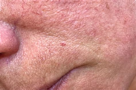 Common Triggers For Rosacea Advice Information