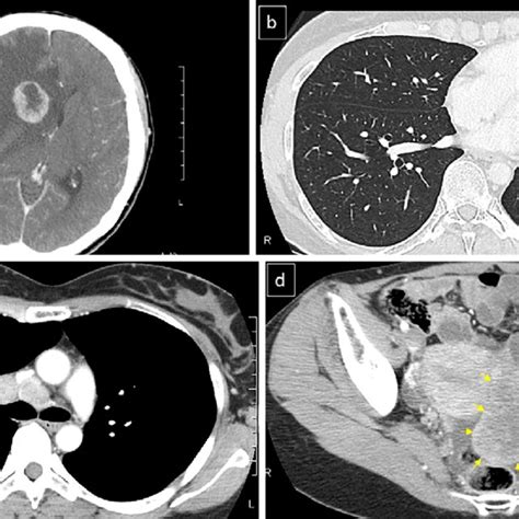 Figure1contrast Enhanced Computed Tomography At The Initial