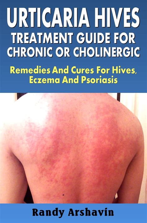 urticaria hives treatment guide for chronic or cholinergic remedies and cures for hives