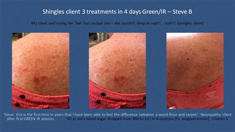 Dpl Light Therapy Before And After Shelly Lighting