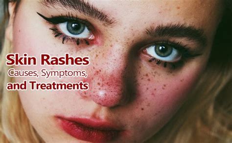 Understanding And Managing Skin Rashes Causes Symptoms And Treatments