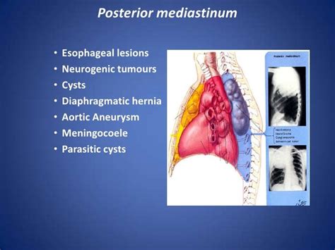 Anatomy Of Mediastinum And Its Disorders