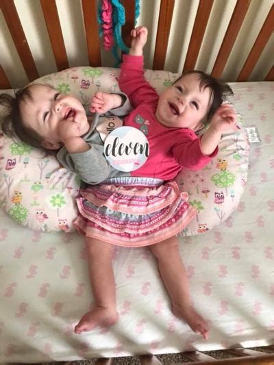 First Birthday Conjoined Twins In Blackfoot Continue To Beat Odds Local