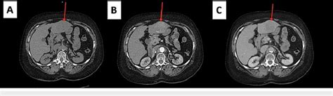 Triple Phase Ct Scan Of The Liver A Non Contrast Image Showing An