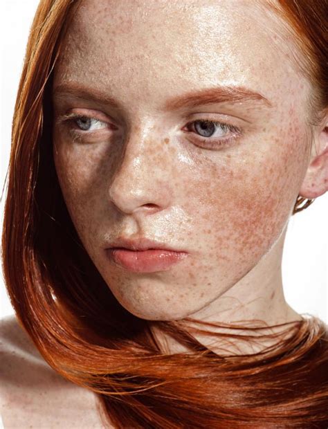 What Is The Connection Between Red Hair And Freckles
