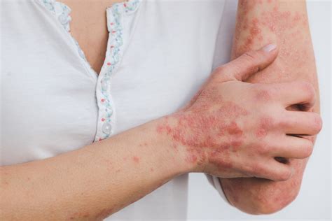 What Is Psoriasis And How To Deal With It Health And Beauty Insights