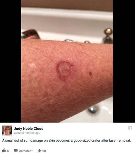 Woman Shares The Dangers Of Using A Tanning Bed Without Sunscreen With