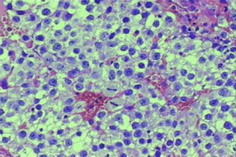 Uniform Large Tumor Cells With Large Nuclei Prominent Nucleoli And