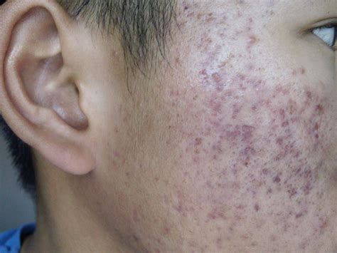 Help Very Severe Acne Scars Hyperpigmentation Redness