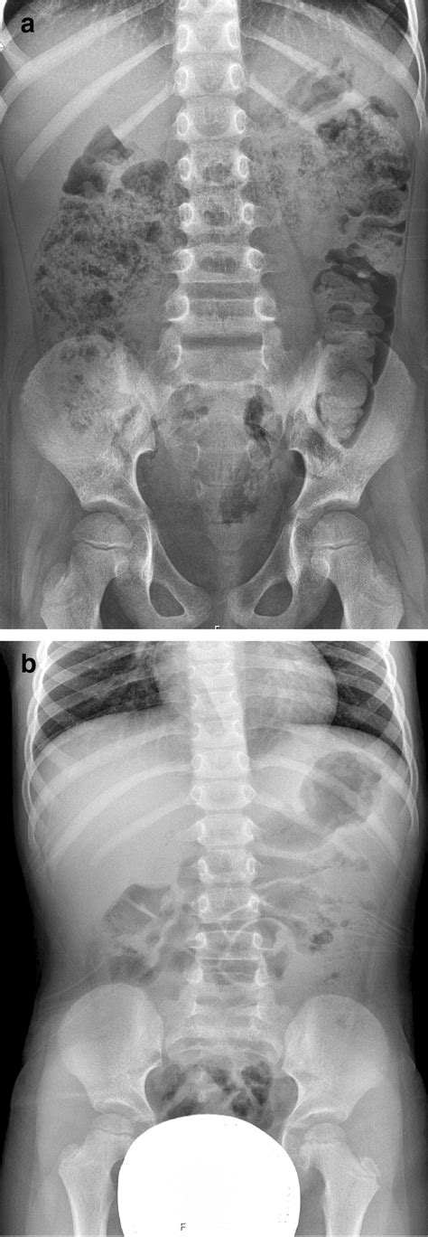 A Abdominal X Ray In A Patient With Arm With Constipation Fecal