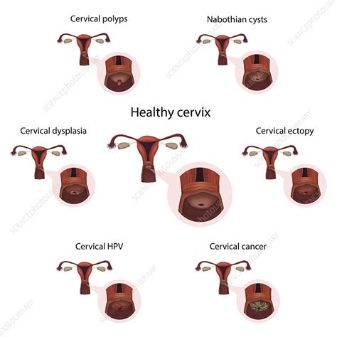 Cervical Diseases And Healthy Cervix Illustration Stock Image F028