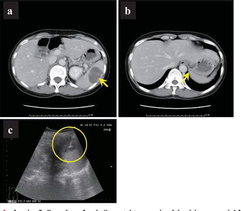 Figure From Multiple Splenic Abscesses In Patients With