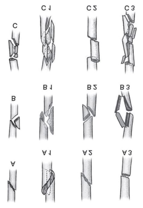 Ao Classification Distal Third Diaphyseal Fractures Of The Humerus