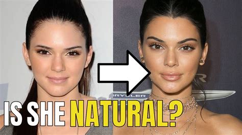 Kendall Jenner Plastic Surgery Before And After Photos 395