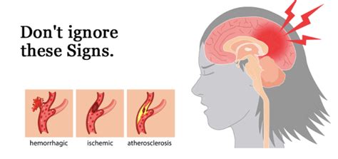 8 Signs You Had A Stroke And Might Not Know It Dont Ignore These Signs