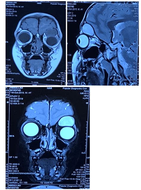 A Case Report On Intraorbital Extraconal Dermoid Cyst Surgical Case