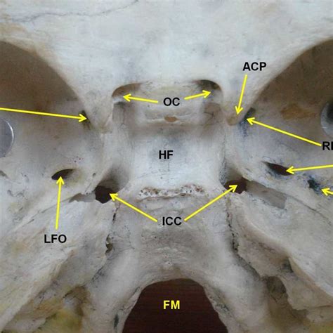 Photograph Of The Middle Cranial Fossa Showing Confluent Foramen Ovale