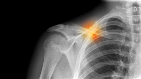 Causes Of Collarbone Pain Everything You Need To Know