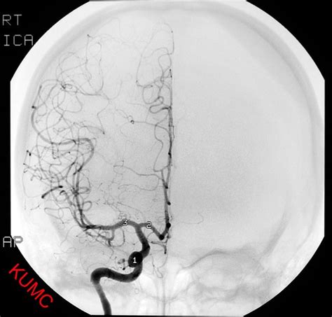 Cerebral Angiogram From Ku Radiographic Anatomy Interventional