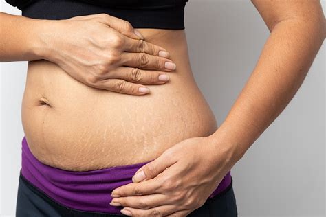 What Are Stretch Marks And How You Can Prevent Them