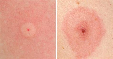 Types Of Insect Bites 5 Types Of Bug Bites You Should Never Ignore