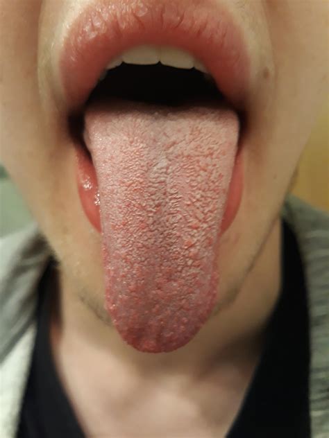 Seit Einer Woche Weißer Belag Auf Der Zunge Gesundheit Und Medizin