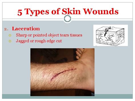 Skin Wounds Obj I Will Differentiate Between Common