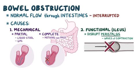 Laparoscopic Management Of Acute Intestinal Obstruction Omics Hot Sex Picture