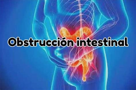 ¿qué Es La Obstrucción Intestinal Síntomas Causas Y Cómo Tratar La