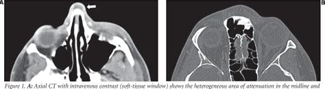 Figure 1 From Adult Nasal Dermoid Sinus Cyst Semantic Scholar
