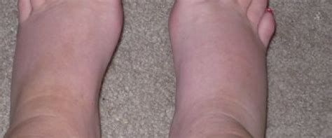Swollen Top Of Foot Ankle Any Pain 10 Causes Treatment