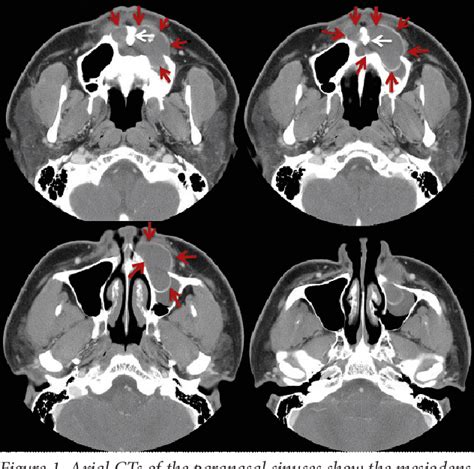 Figure 1 From Extensive Dentigerous Cyst Associated With A Mesiodens