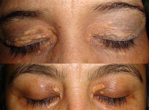 Xanthoma Eye Tendinous Tuberous And Disseminatum Causes And Treatment