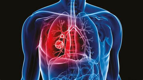 Advanced Lung Cancer Treatment Lung Cancer Treatment Cost In India