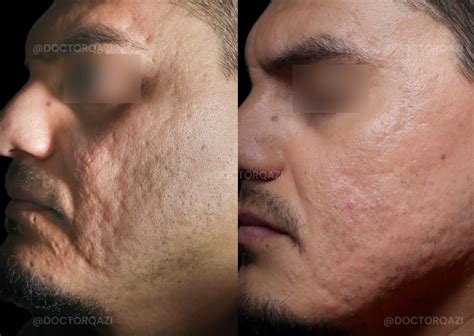 cicatrices de acné qazi cosmetic center