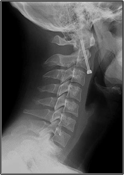 Clinical Anatomy Radiology Lateral Neck