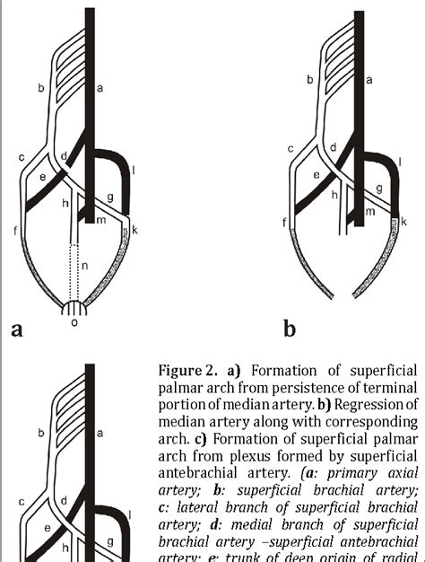 Figure 1 From Subcutaneous Superficial Palmar Arch An Unusual Variant