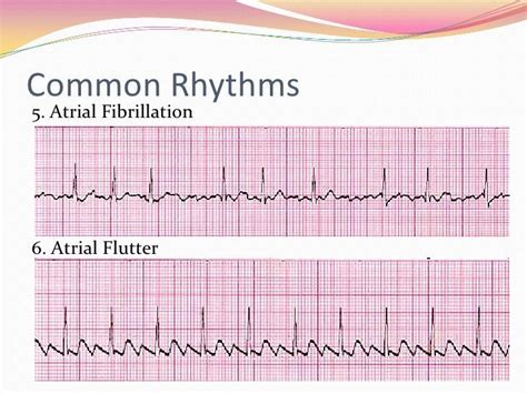 How To Read A 12 Lead Ecg