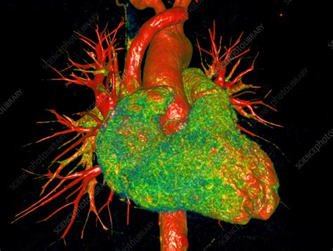 Healthy Heart Ct Scan Stock Image C0573532 Science Photo Library