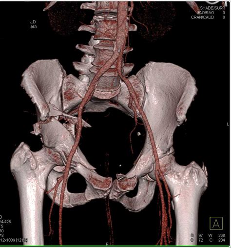 Comminuted Pelvic Fracture With Splenic Bleed As Well Musculoskeletal
