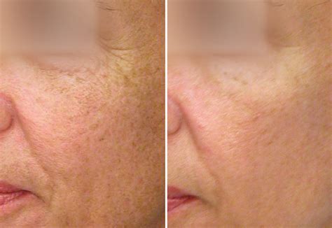 Laser Peels Remington Aesthetics And Cosmetic Surgery