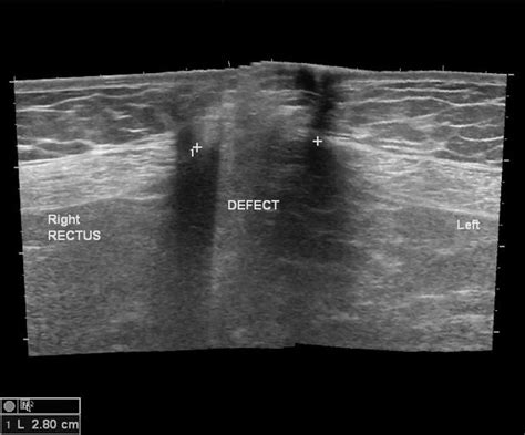 Ventral Hernia Ultrasound