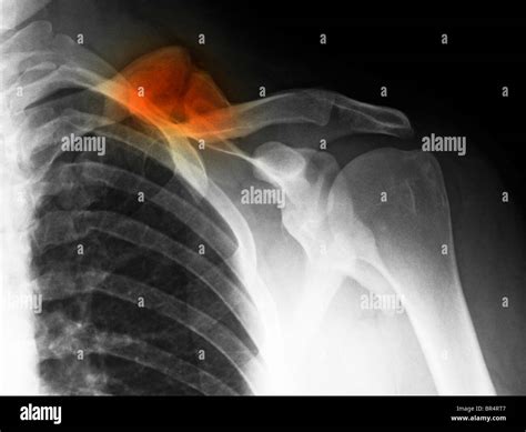 X Ray Showing A Healed Fracture Of The Collarbone Clavicle Of A 34