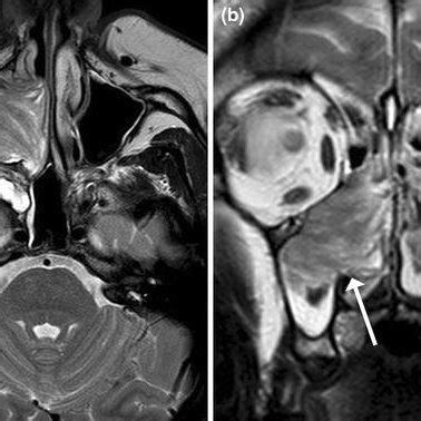 Inverted Papilloma Axial A And Coronal B T2 Weighted MRI Images