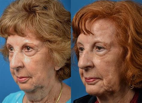 Patient 122406524 Laser Assisted Weekend Neck Lift Before And After